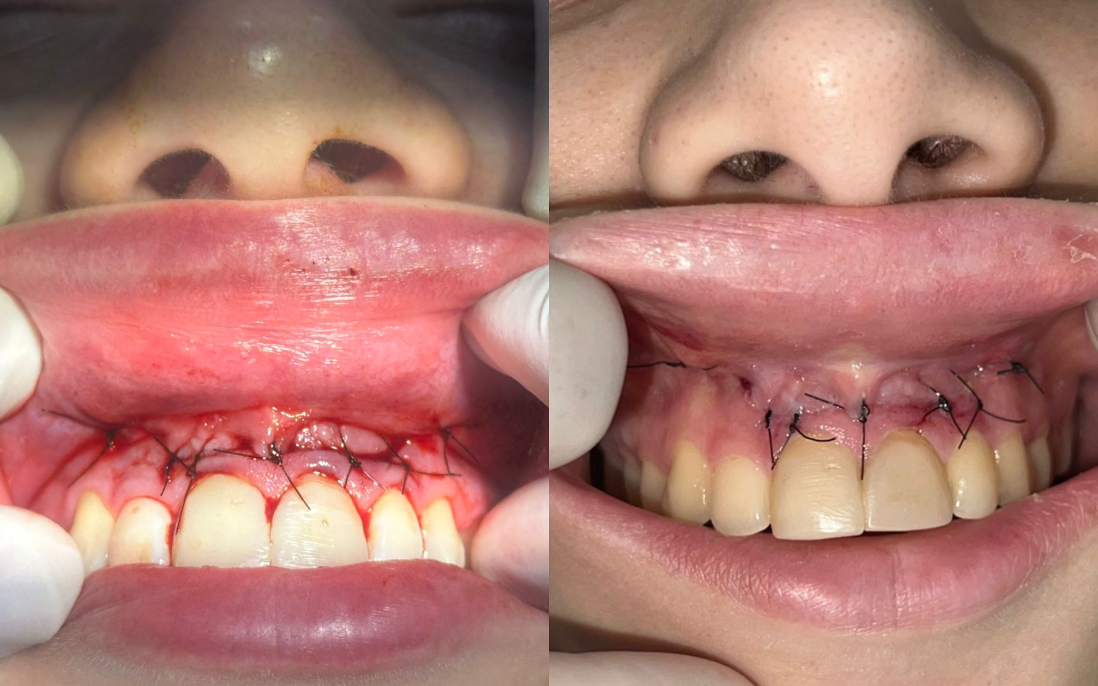 Pós-Cirúrgico de Paraendodôntica — Antes e Depois